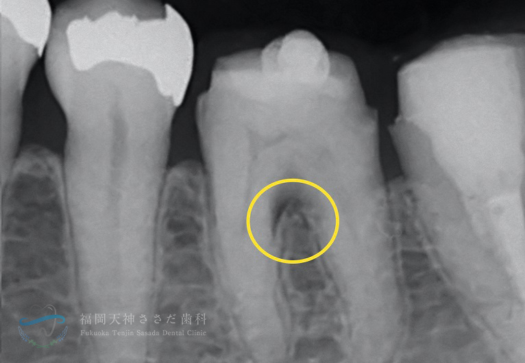 「重度歯周病治療」Case2　術後