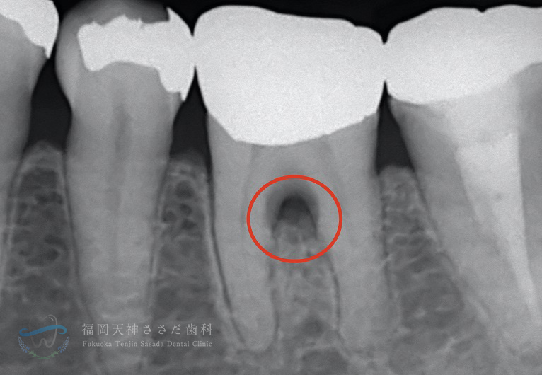 「重度歯周病治療」Case2　術前