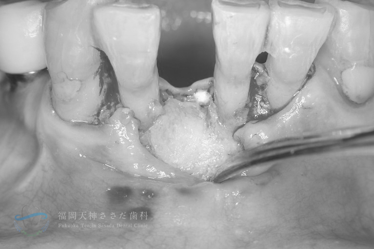 Case4 インプラント手術