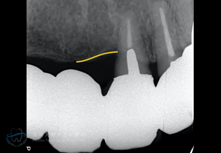 「重度歯周病治療」Case3 術後(10年経過のレントゲン)