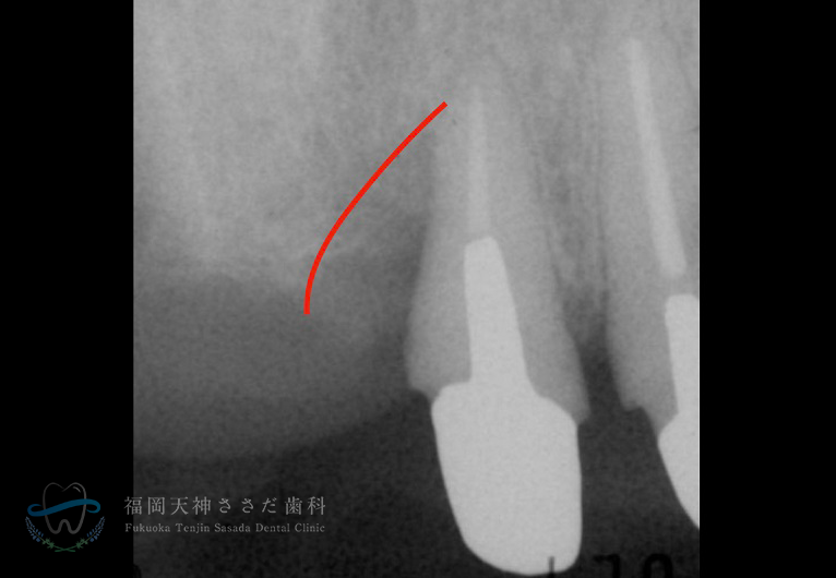「重度歯周病治療」Case3 術前(レントゲン)