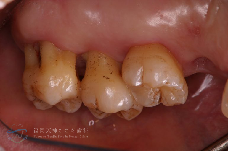 歯石除去の症例・after