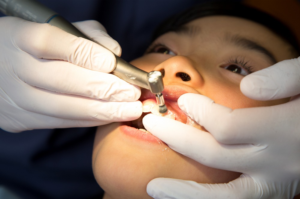 石除去・歯のクリーニングの重要性