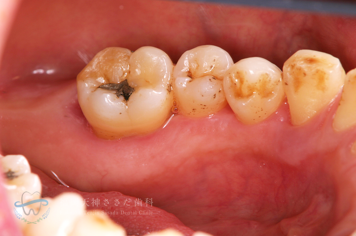 歯石除去の症例・after
