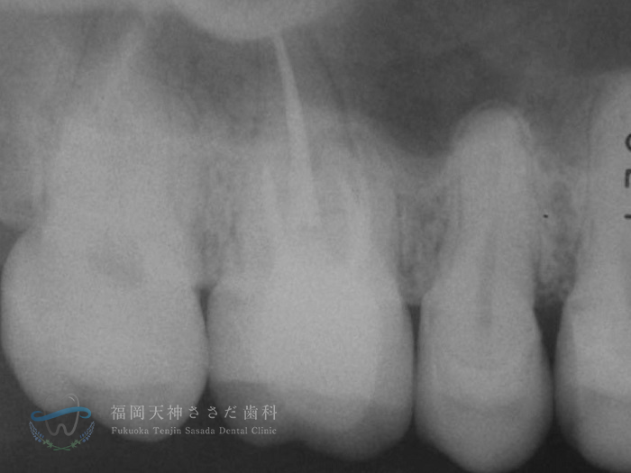 根管治療の症例・after