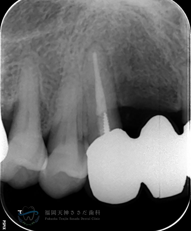 根管治療の症例・after