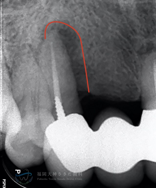 根管治療の症例・before