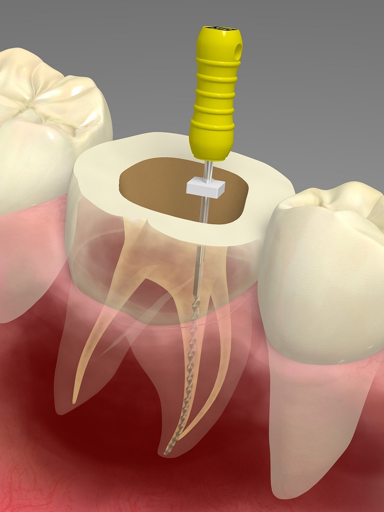 神経を取る治療（根管治療）とは？