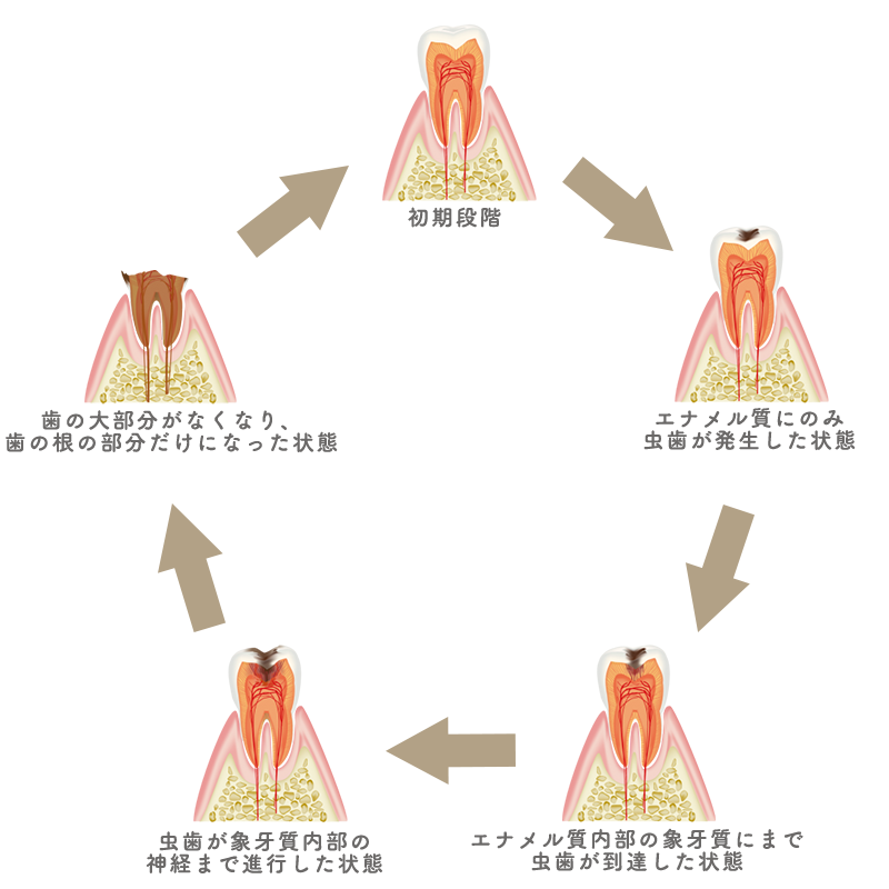 虫歯の進行