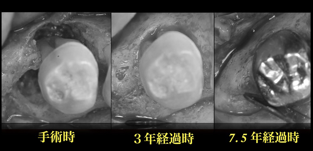 「重度歯周病治療」の術後