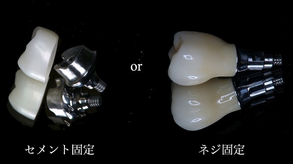 精度の高い被せ物をスクリュー固定（ネジ止め）で製作する