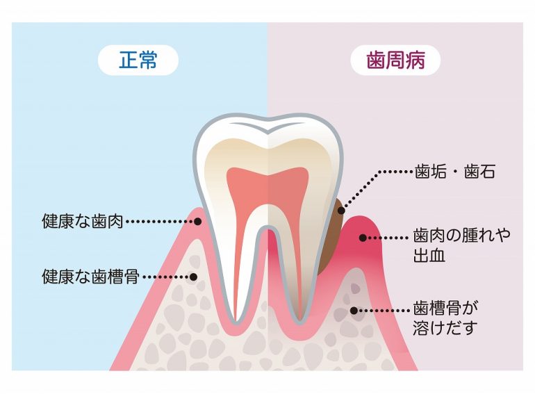 気づかぬうちに進行する歯周病