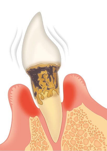 重度の歯周病治療にも対応します