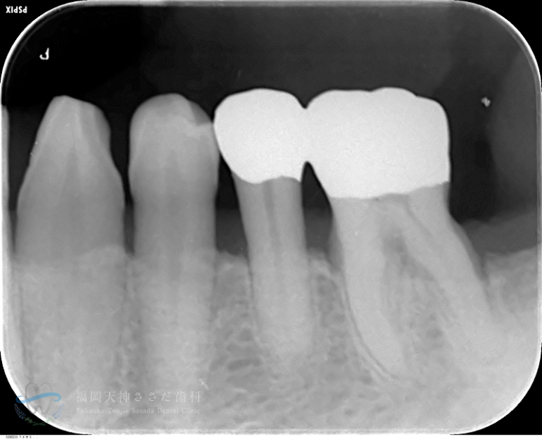 歯周外科治療の症例・after