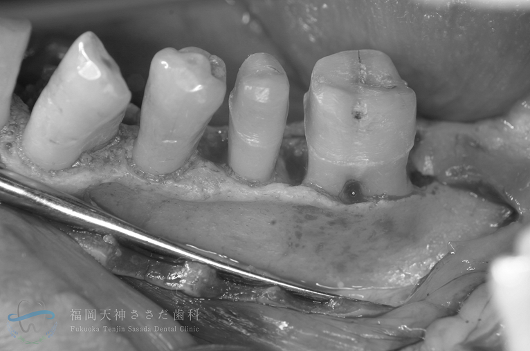 歯周外科治療の症例・術中