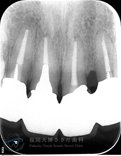 歯周外科治療の症例・術後（13年後レントゲン）