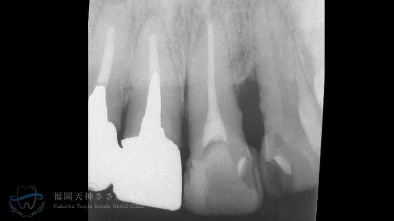 歯周外科治療の症例・before