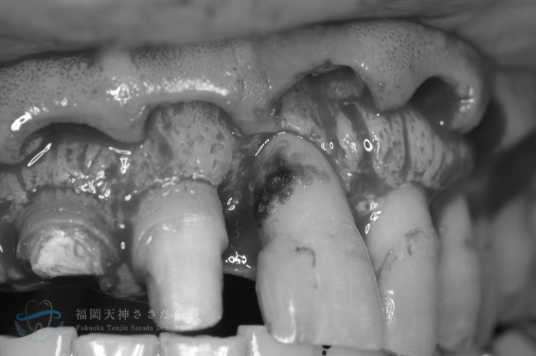 歯周外科治療の症例・術中歯石除去前