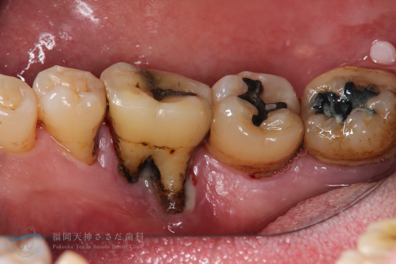 歯周外科治療の症例・before（右下術前）