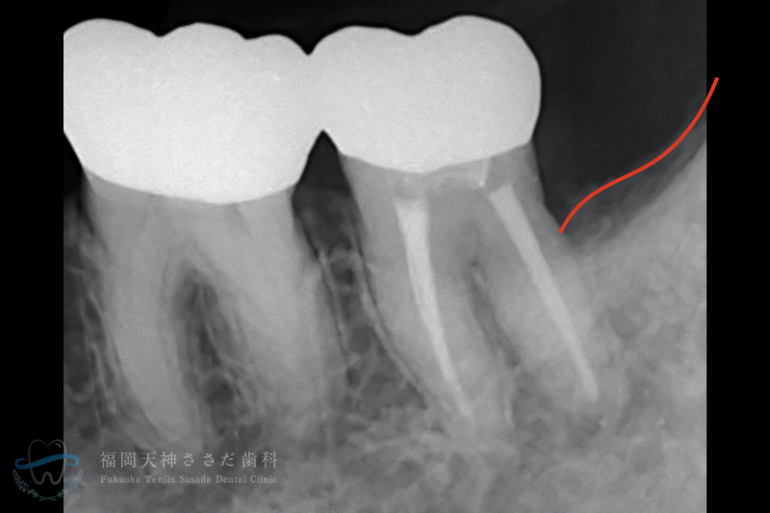 歯周外科治療の症例・術後（7年経過時レントゲン）