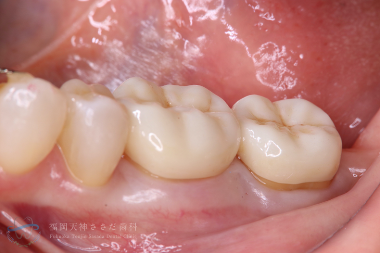 歯周外科治療の症例・術後（7年経過時）
