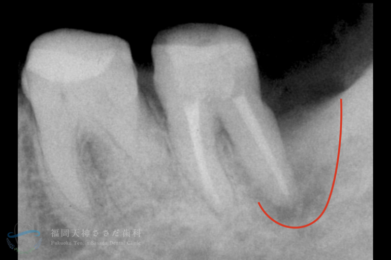 歯周外科治療の症例・before