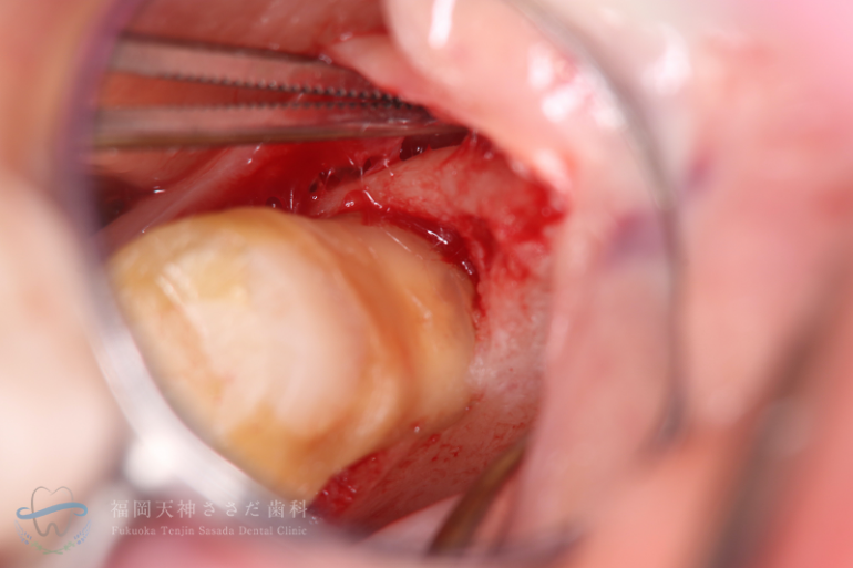 歯周外科治療の症例・再手術時