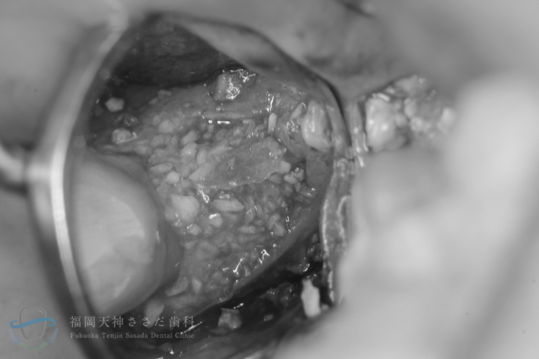 歯周外科治療の症例・術中2