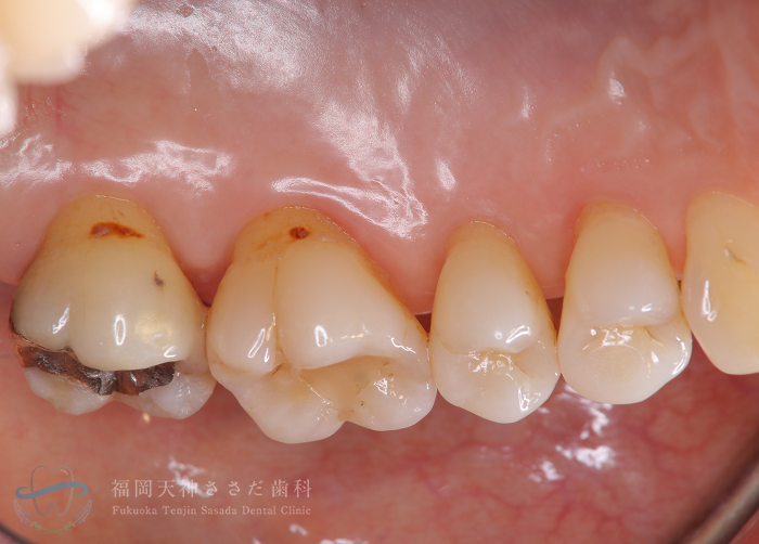 歯周外科治療の症例・術後（7年後）