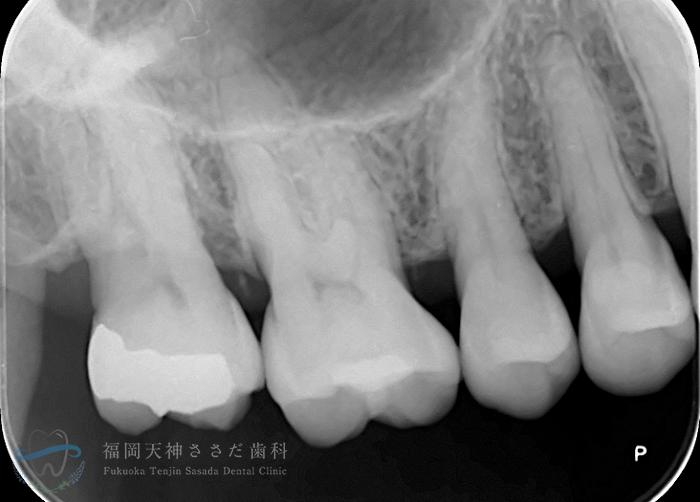 歯周外科治療の症例・術後（7年後レントゲン）