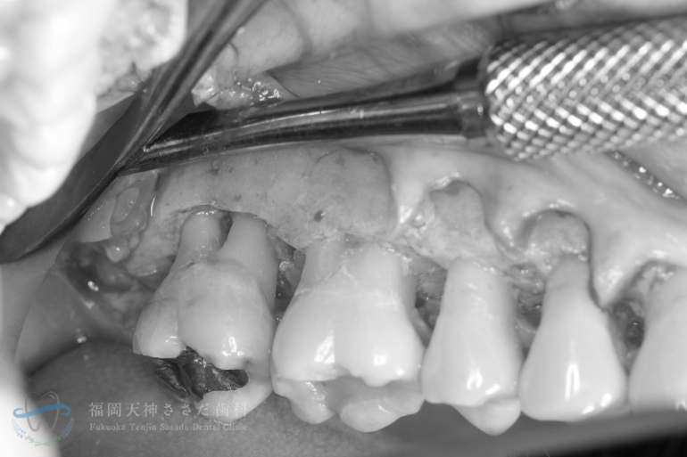 歯周外科治療の症例・術中