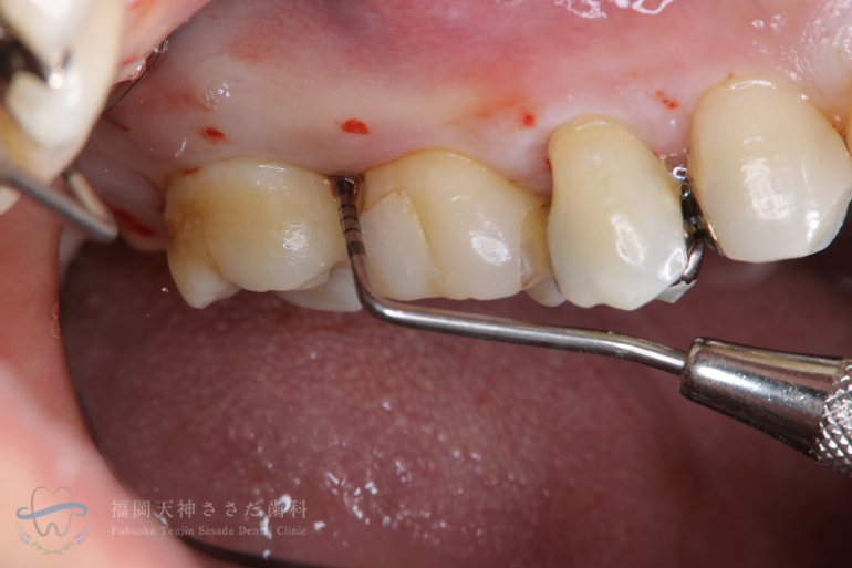 歯周外科治療の症例・術前