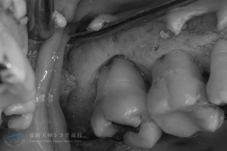 歯周外科治療の症例・術中