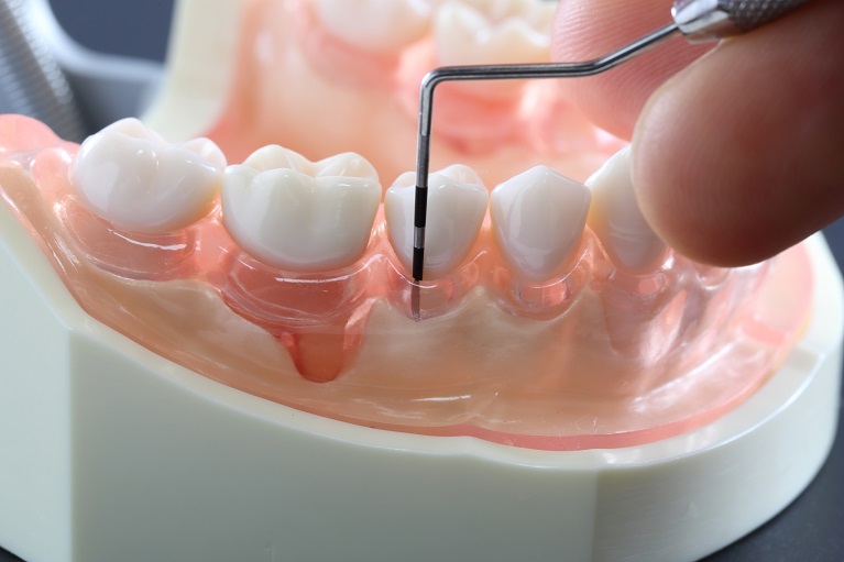 歯と歯茎の境目の歯周ポケット