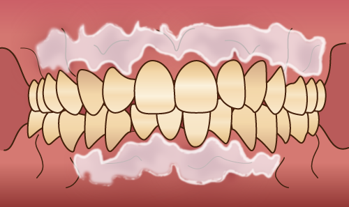 歯茎の黒ずみ除去「ガムピーリング」