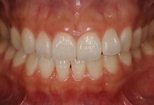 上の前歯の歯茎のライン