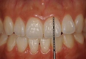 上の前歯の長さ（平均10〜11mm）
