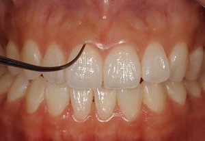 歯に対する歯茎の位置（歯茎の位置異常の検査）