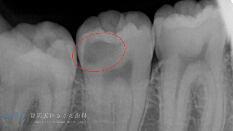 治療前レントゲン