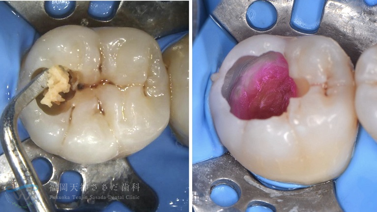 虫歯除去（途中）