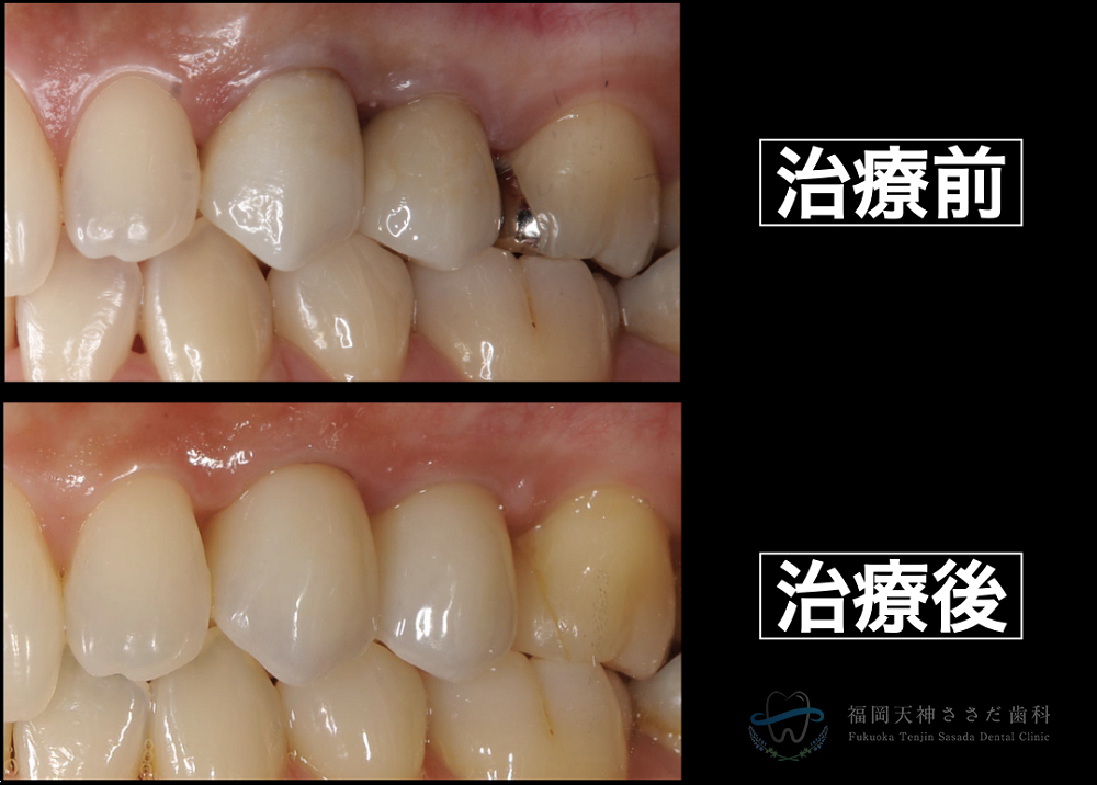 セラミック術前術後の比較