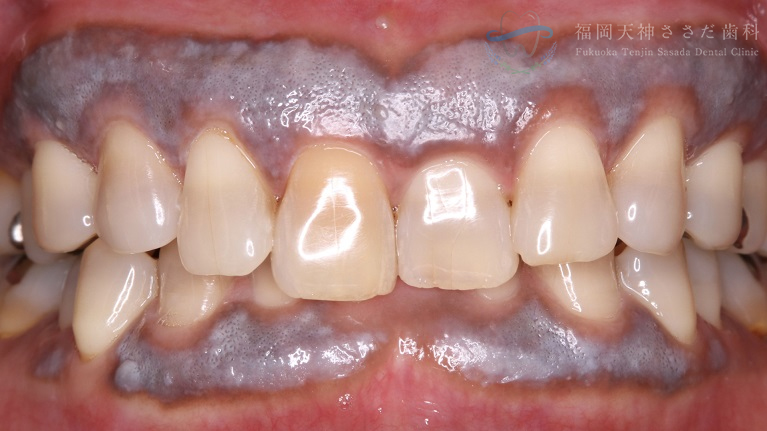 歯茎の黒ずみ除去