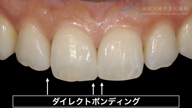 ダイレクトボンディングの症例