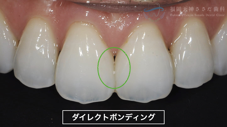 ダイレクトボンディングの症例・術後の解説