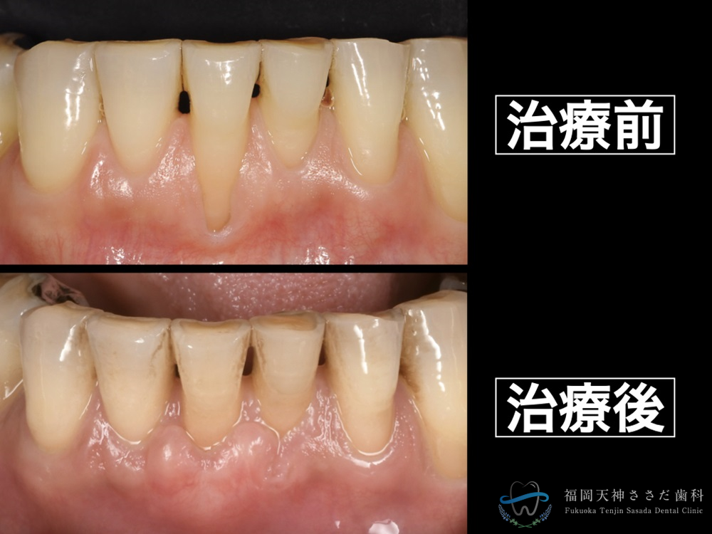 歯肉移植の症例・治療前後の比較