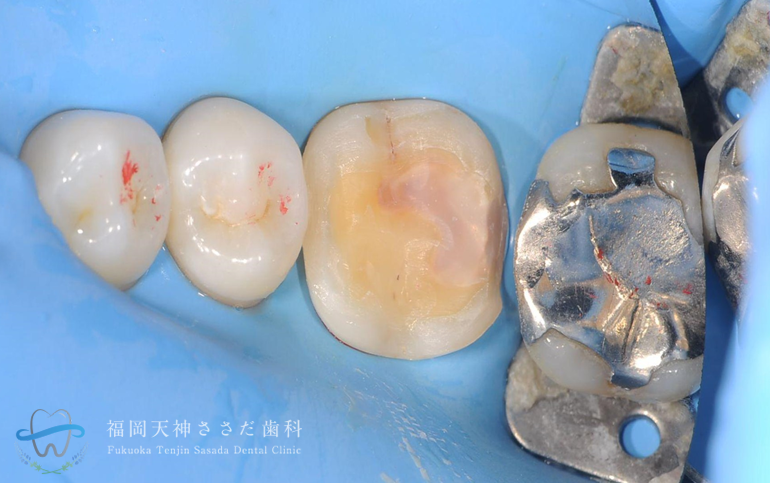 テーブルトップの症例