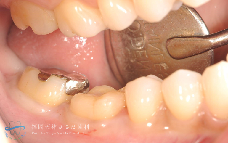 テーブルトップの症例