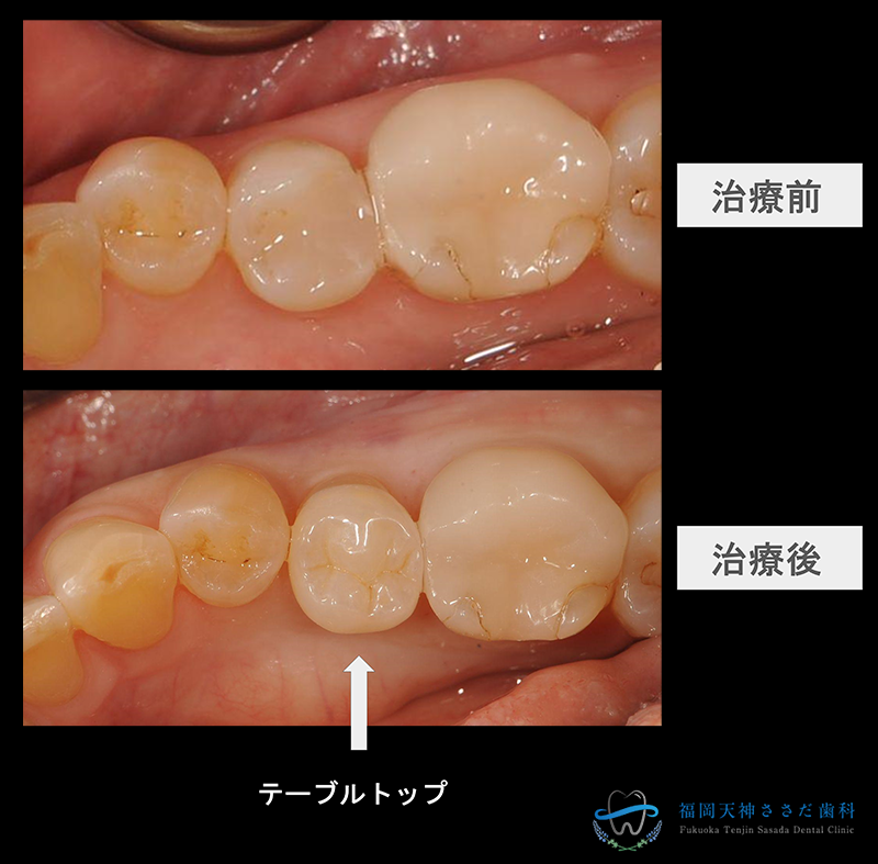 テーブルトップの症例
