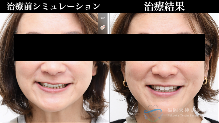 治療前シミュレーションと治療結果の比較